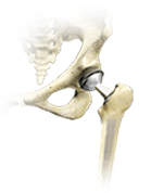 Hip-Joint-Replacement-img