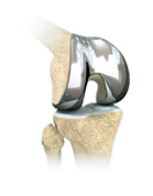 Knee-Joint-Replacement-img